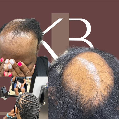 ALOPECIA Braids