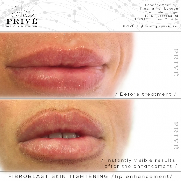 What Is A Plasma Pen Lip Flip