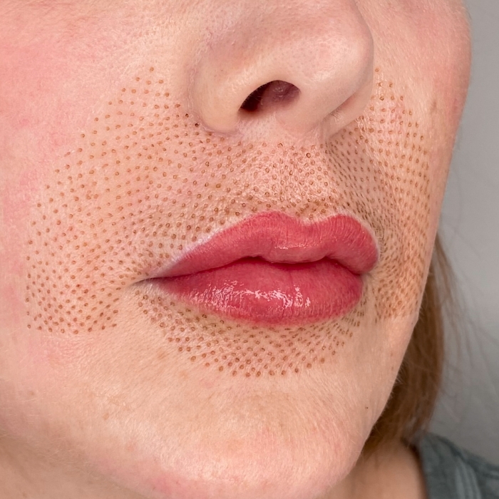 What Is A Plasma Pen Lip Flip