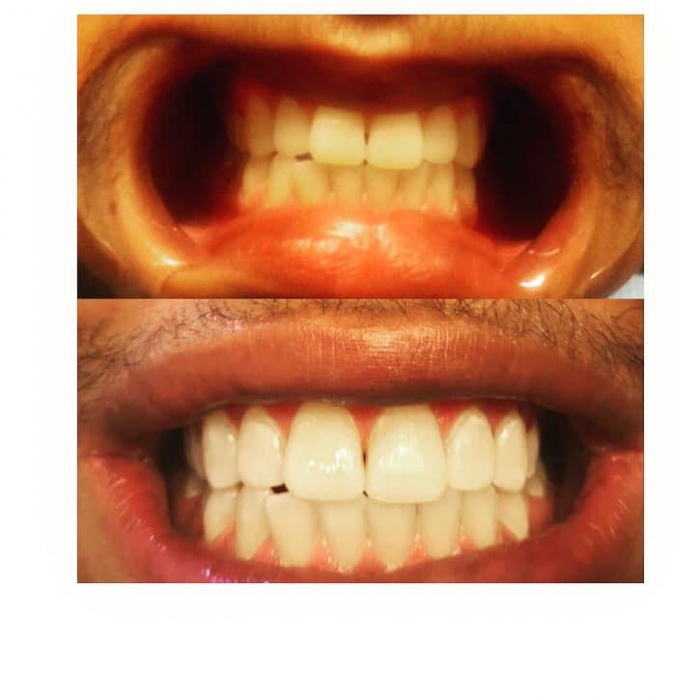 Schedule Appointment with Indemand Teeth Whitening