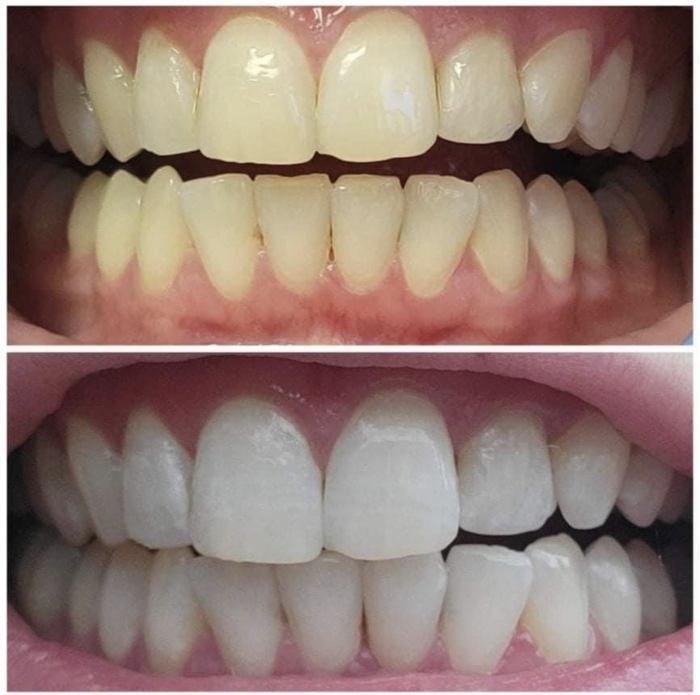 Schedule Appointment with AFTERGLO TEETH WHITENING